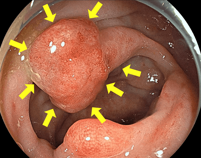 早期大腸がん（大腸ポリープ）