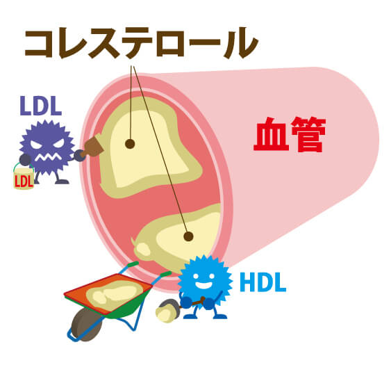 脂質異常症_HDLとLDLコレステロール