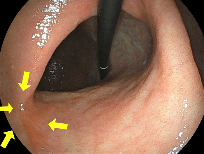 胃潰瘍瘢痕（胃変形例）