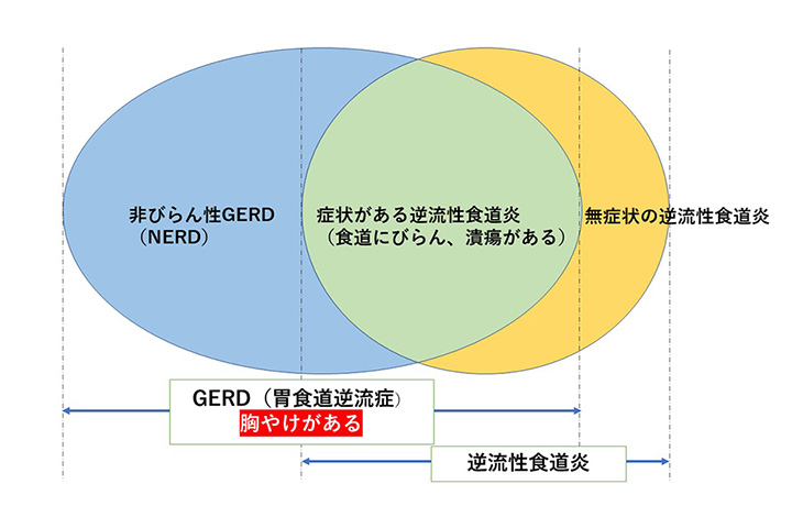 逆流性食道炎に対して内視鏡検査が推奨されるのはどのような場合ですか?
